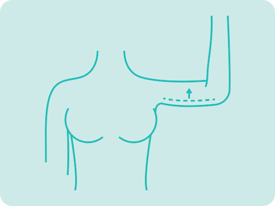 cirurgia plastica bracos