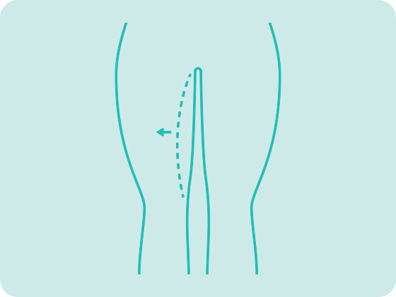 cirurgia plastica coxas dermolipectomia