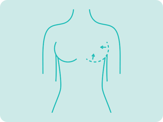 cirurgia plastica mamoplastia redutora mastopexia